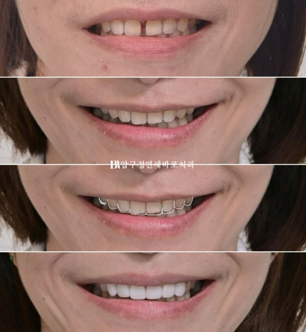 벌어진 치아 교정 인비절라인 라이트 무삭제 라미네이트 치료 관련 이미지 25