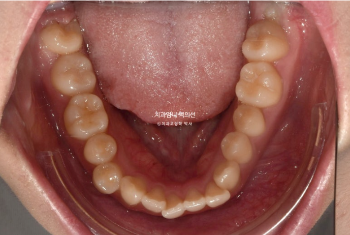 인비절라인 교정 비발치 비대칭 덧니 중심선 선천적 결손치 교정? 관련 이미지 6
