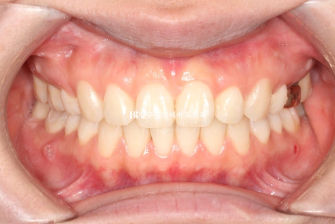 Gummy Smile Correction, Gummy Smile Orthodontics, Rabbit Teeth Correction image 8