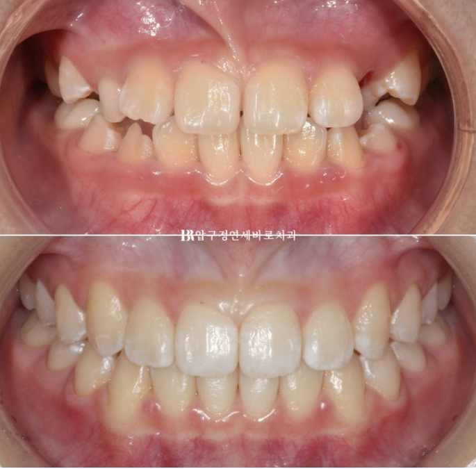 Simultaneous Arch Expansion and Teeth Alignment for Elementary School Children with Invisalign｜Invisalign First image 16