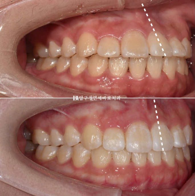 인비절라인라이트 재교정 뻐드렁니 교정 돌출 교정 관련 이미지 8