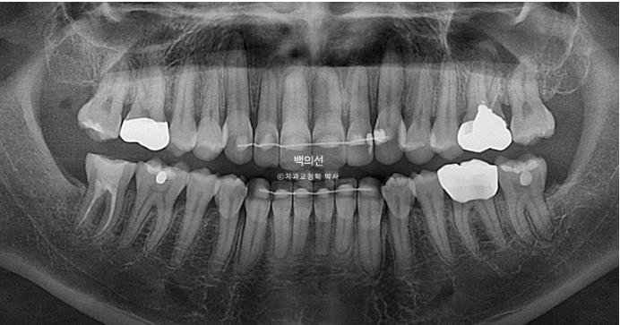 Treatment Review: No-Prep Laminate for Tetracycline-Stained Teeth image 22
