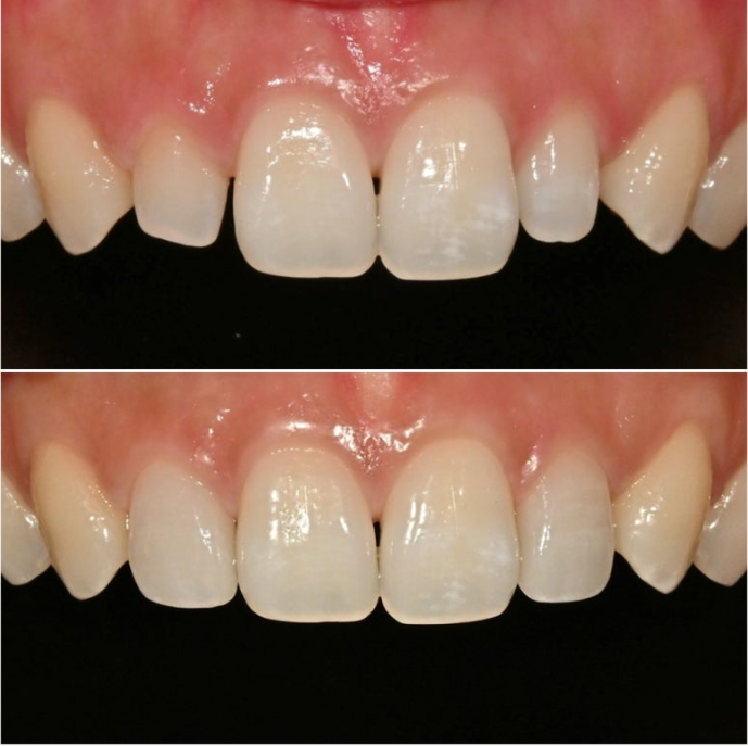 왜소치 반점치 (반상치)가 있는 경우 무삭제 라미네이트 치료 관련 이미지 1