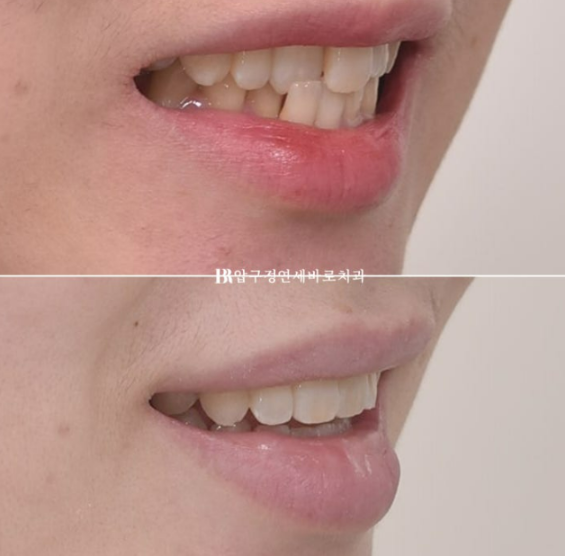 앞니부분교정 기간? MTA 미니튜브 교정 반대교합 교정 관련 이미지 10