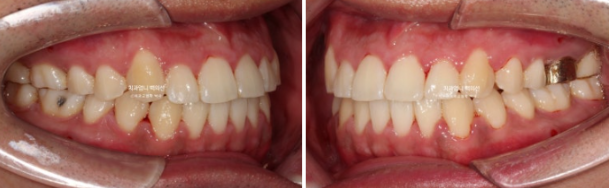 반대교합 비발치 교정 클리피씨 후기 관련 이미지 7