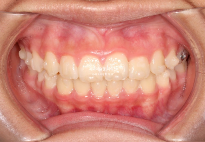 덧니 반대교합 과개교합 인비절라인 퍼스트 악궁확장 어린이 교정 치료 관련 이미지 14