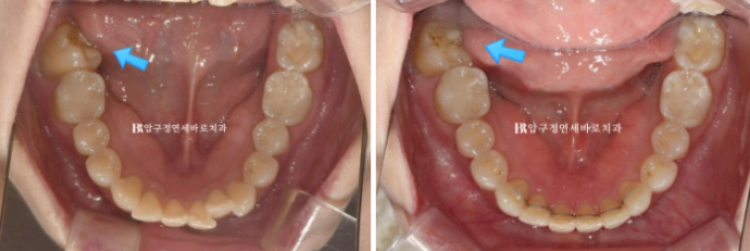 Invisalign Lite for Orthodontic Treatment in Your 40s: Crossbite and Protrusive Mouth Correction image 16