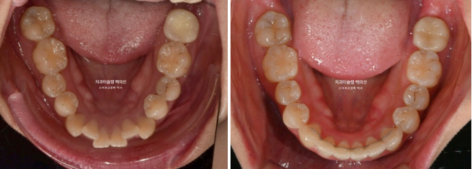 인비절라인 돌출입 발치교정 임플란트 없이 사랑니 대체 관련 이미지 21
