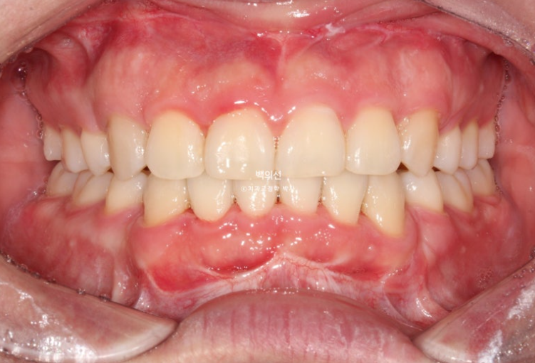 돌출입 수술 ASO + 인비절라인 라이트 후교정 치료기간 10개월 관련 이미지 12