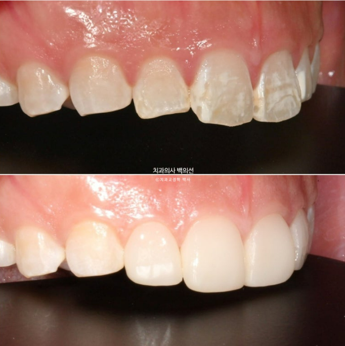 반점치 반상치 치아 하얀 얼룩 치료하기 관련 이미지 6