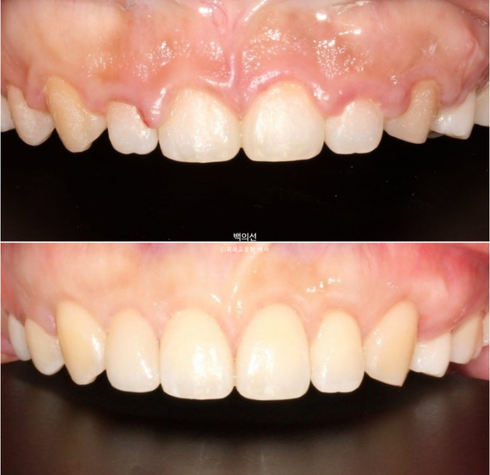 30대 치아교정 돌출입 교정 :: 잇몸미소 거미스마일 교정 입술부전증 결손치 무턱교정 관련 이미지 21