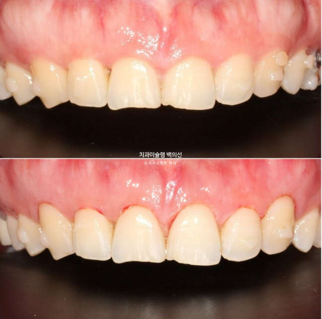비발치 덧니 교정 인비절라인 과개교합 교정 무삭제 라미네이트 치료 후기 관련 이미지 13