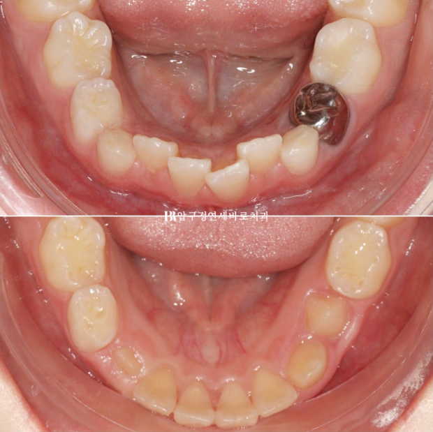 소아 투명교정 인비절라인 퍼스트 후기 기록 관련 이미지 18