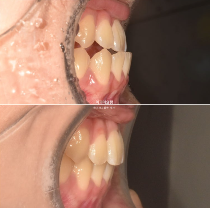 비발치 비수술 주걱턱 반대교합 재교정 치료 관련 이미지 15