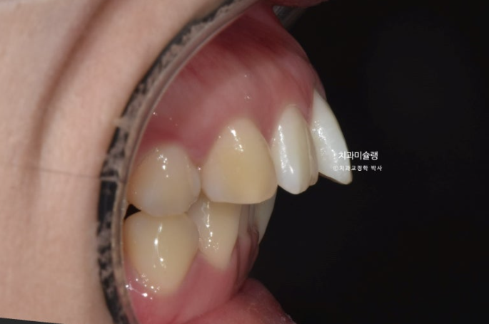 돌출입 덧니 발치 교정 인비절라인 교정 후기 관련 이미지 3