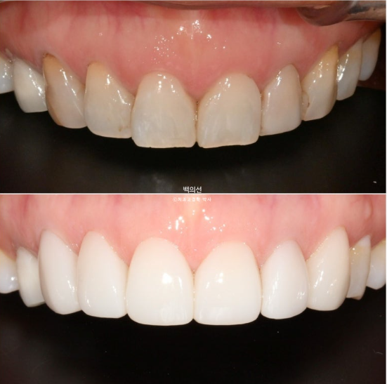 40대 무삭제 라미네이트 블랙트라이앵글 레진 치료 관련 이미지 7