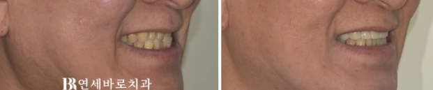 60대 무삭제 라미네이트 앞니 부분교정 치료 관련 이미지 11