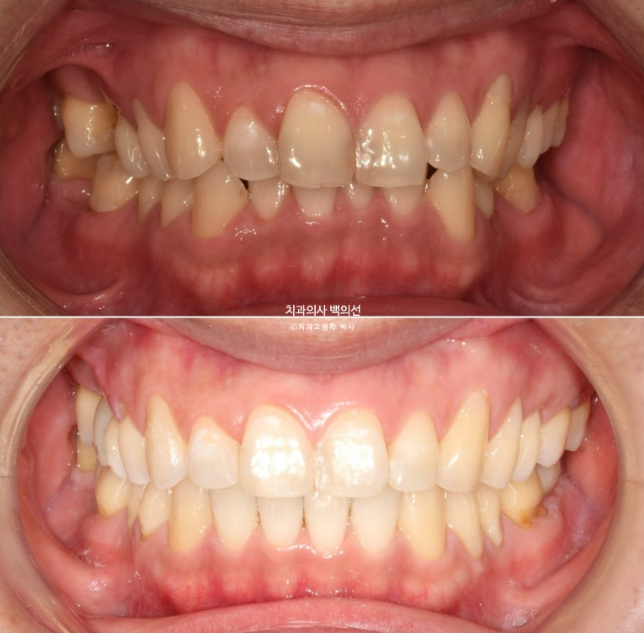 40대 인비절라인 라이트 과개교합 과잉치 덧니 교정 임플란트 보철 교정 후기 관련 이미지 20