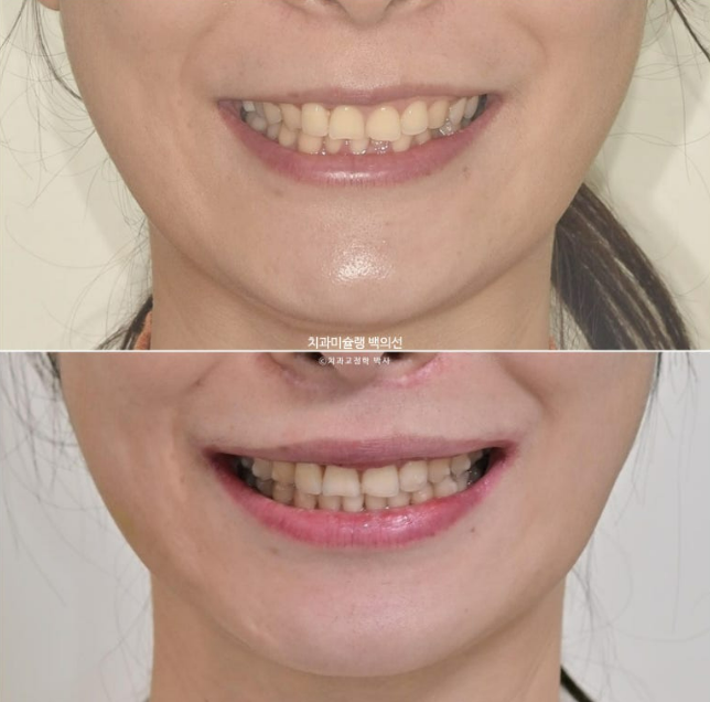 비발치 덧니 교정 인비절라인 과개교합 교정 무삭제 라미네이트 치료 후기 관련 이미지 11