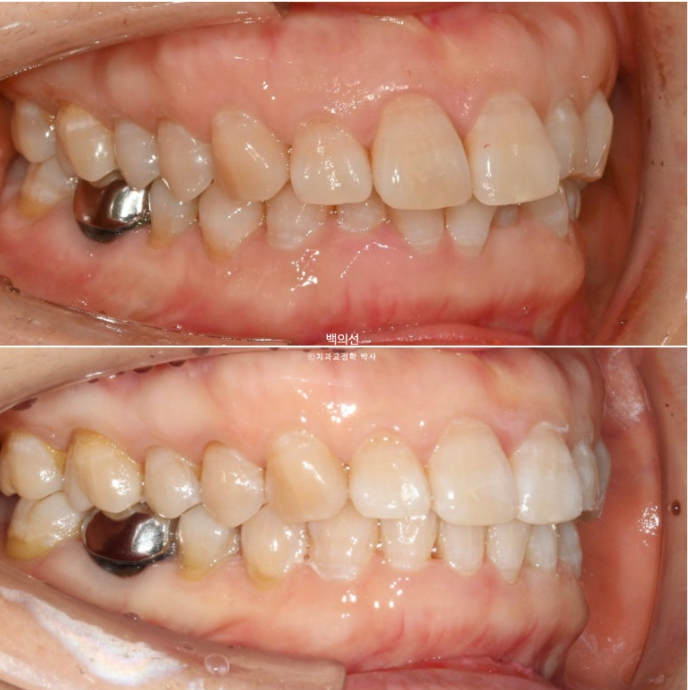 40대 인비절라인 라이트 앞니 돌출 과개교합 덧니 교정 후기 관련 이미지 16