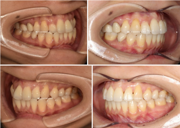 Gangnam Orthodontic Clinic: A Woman in Her 30s’ Rabbit Teeth Correction Review|Six-Month Front Teeth Partial Orthodontic Treatment That Also Improved a Crossbite image 7