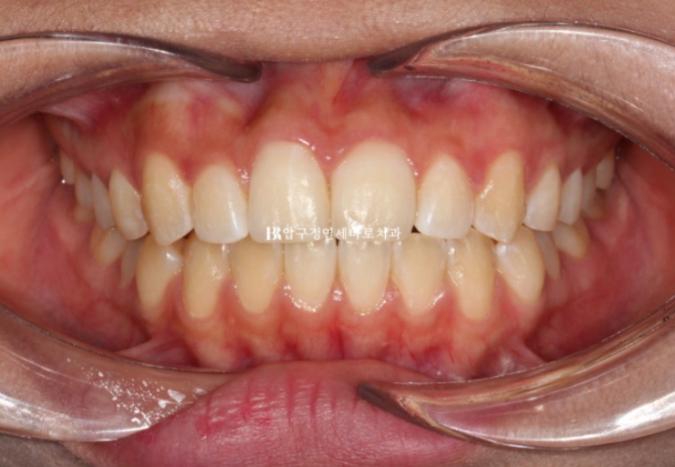 덧니교정 앞니부분교정 치간삭제 후기 관련 이미지 6