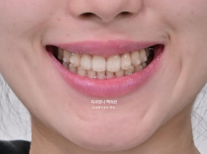 인비절라인 교정 비발치 비대칭 덧니 중심선 선천적 결손치 교정? 관련 이미지 13