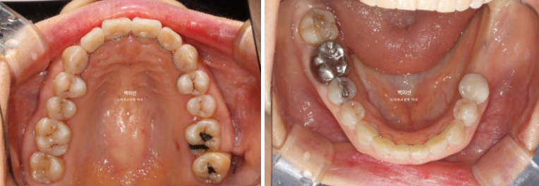 40대 인비절라인 라이트 앞니 돌출 과개교합 덧니 교정 후기 관련 이미지 14