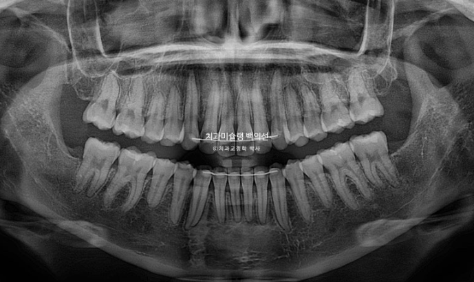 비발치 인비절라인 교정 돌출입 교정 후기 관련 이미지 22