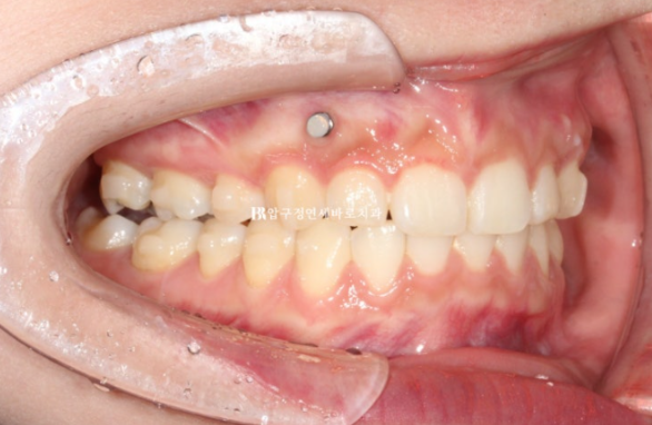 Can't Invisalign Move the Roots? An Actual Case of Extraction Treatment for Protruding Mouth at a Gangnam Orthodontic Clinic image 8