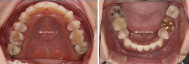 Can Invisalign Lite Work for People in Their 50s? A Real Middle-Aged Orthodontic Case Improving Butterfly Teeth and Gum Recession image 8