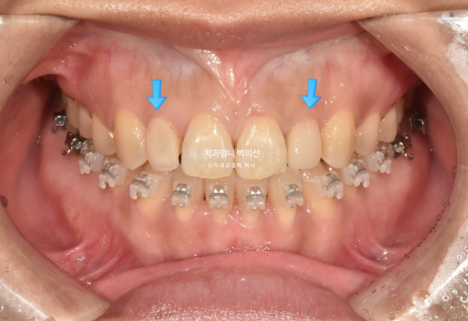 비수술 개방교합 클리피씨 30대 무삭제 라미네이트 치료기간 2년 관련 이미지 9
