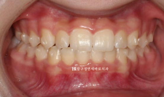 서울 인비절라인 덧니 교정 과개교합 후기 관련 이미지 2
