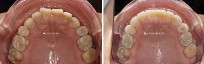50대 라미네이트 삭제 없이 하는 법? 관련 이미지 13