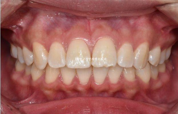 How Do the Buccal Corridors and Smile Line Change After Extraction Treatment for Protruding Teeth?|An Orthodontic Case That Also Improved Lip Incompetence image 2