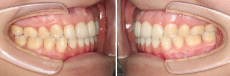 클리피씨 교정에서 인비절라인 변경 마무리 인비절라인 라이트 치료기간 4개월 관련 이미지 10