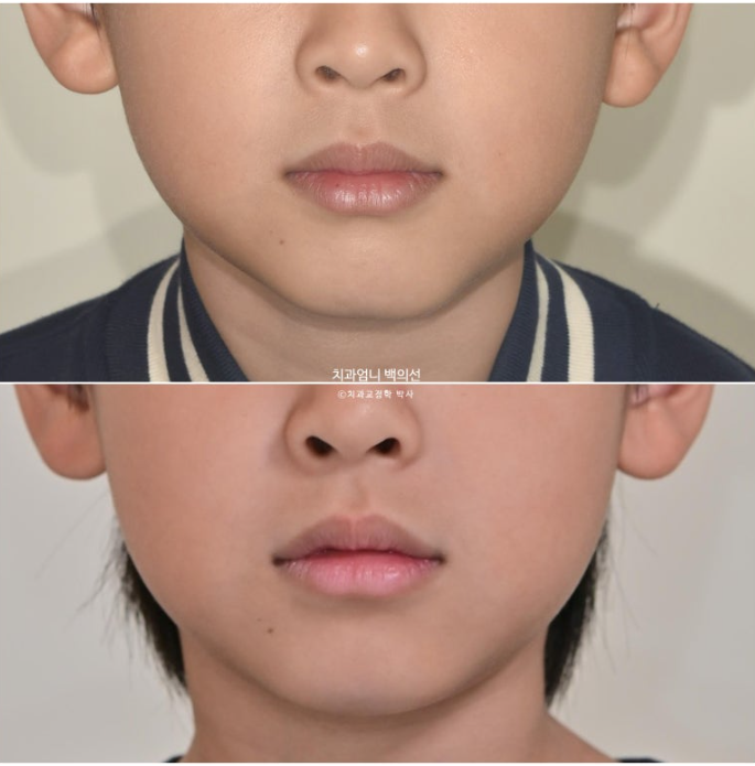 어린이 교정 인비절라인 퍼스트 비대칭 반대교합 어린이 성장 교정 관련 이미지 21