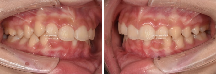 과개교합 인비절라인 모더레이트 컴프레헨시브 중심선 토끼이빨 관련 이미지 3