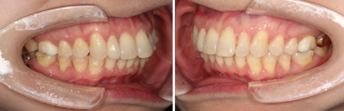 Invisalign Lite for Orthodontic Treatment in Your 40s: Crossbite and Protrusive Mouth Correction image 10