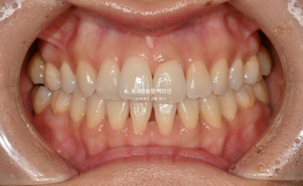 인비절라인 익스프레스 재교정 블랙트라이앵글 치간 삭제 치료기간 6개월 재제작 1회 관련 이미지 2