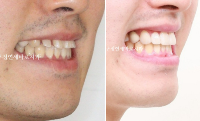 인비절라인 라이트 후 무삭제 라미네이트 치료 관련 이미지 4