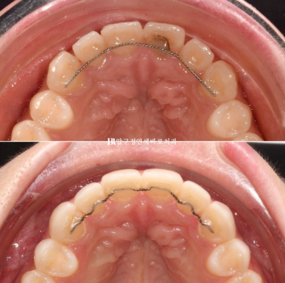 Non-Prep Veneer Review | A Case Naturally Improving Gaps Between the Front Teeth and the Smile Line image 10