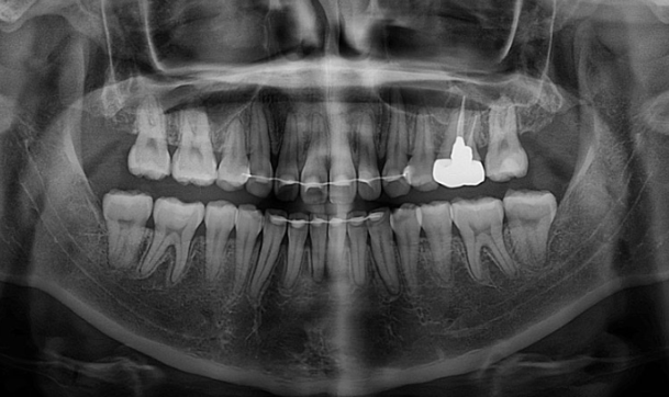 Gummy Smile Correction Review | Natural Improvement of Gummy Smile and Buccal Corridors Through Extraction Treatment for Protruding Teeth image 20