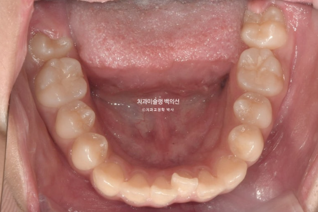 돌출입 무턱 인비절라인 발치교정 덧니 치료기간 1년 11개월 관련 이미지 5