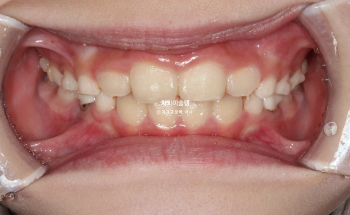 어린이 투명교정 인비절라인 퍼스트 과개교합 교정 후기 관련 이미지 8