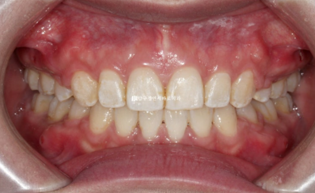A Review of Extraction Orthodontic Treatment for Protruding Mouth | The Details of Orthodontics That Transform Buccal Corridors and Smile Lines image 8
