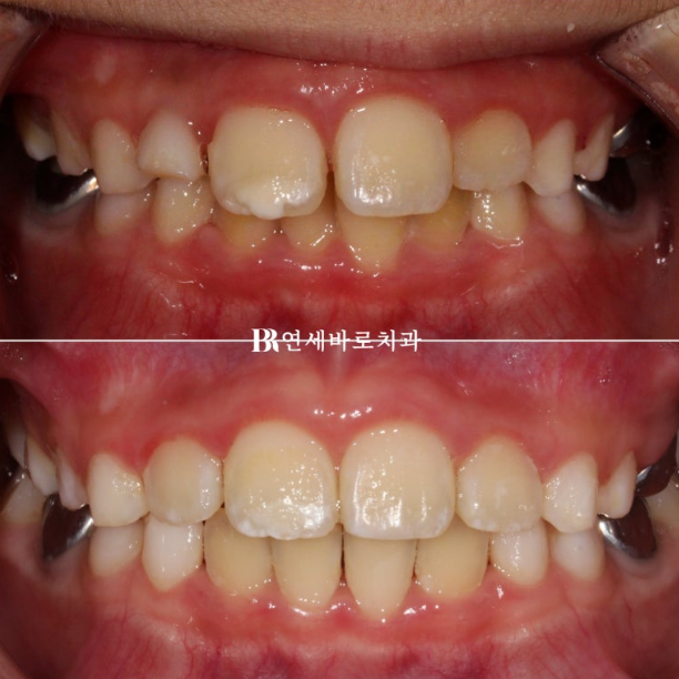 A Real Case of Preventing Crowded Teeth with Invisalign First for a Child in Gangnam image 10