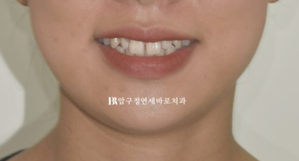 왜소치 인비절라인 라이트 교정 / 무삭제 라미네이트 젤라미 관련 이미지 2