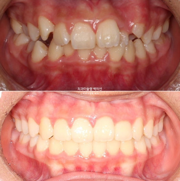 덧니 반대교합 과개교합 인비절라인 퍼스트 악궁확장 어린이 교정 관련 이미지 1