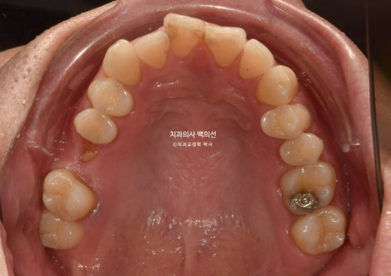 40대 인비절라인 라이트 과개교합 과잉치 덧니 교정 임플란트 보철 교정 후기 관련 이미지 5